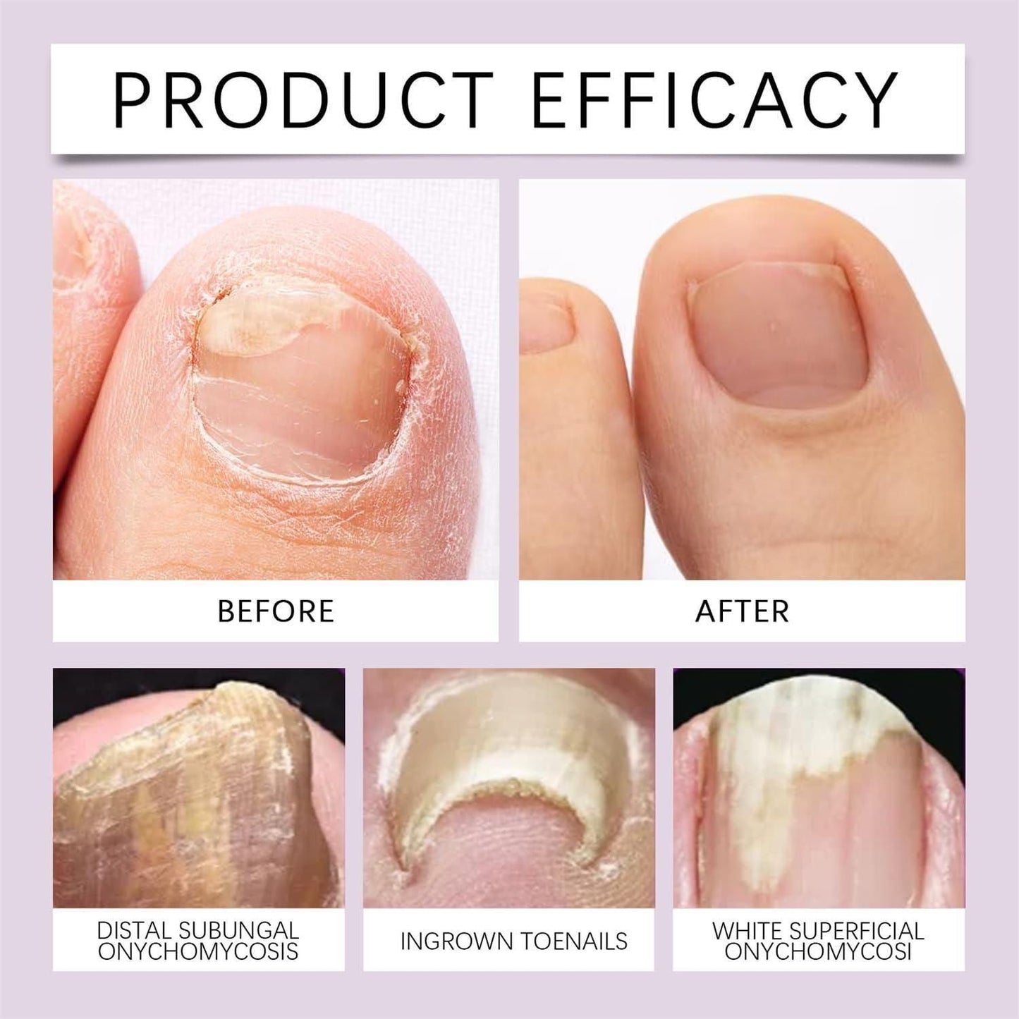 Bee Venom Nail Treatment Serum (Buy 1 Get 1 Free)